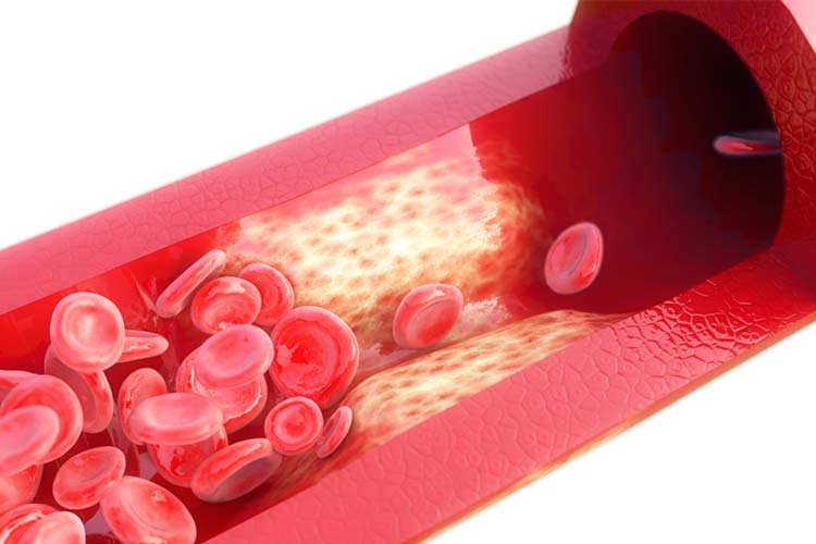 生活習慣病画像